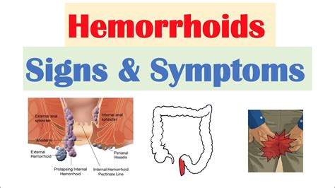 hemorrhoids images female.